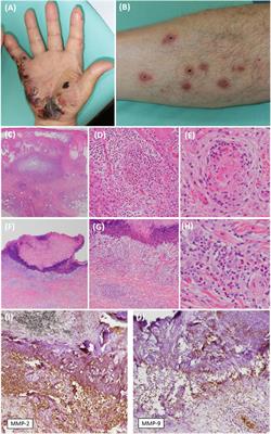 Acquired reactive perforating collagenosis and eosinophilic granulomatosis with polyangiitis developing simultaneously in a diabetic patient